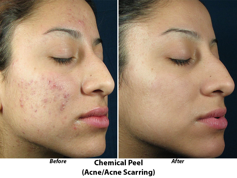 Acne Before and After | Botox Before and After Reston VA
