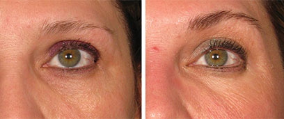 Ultherapy Before and After Reston VA