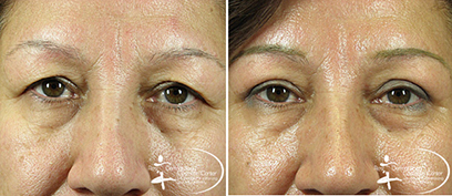 Eyelid Surgery Before and After Reston VA