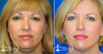Liposuction Before and After Reston VA