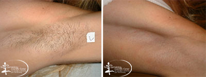 Laser Hair removal Before and After Reston VA