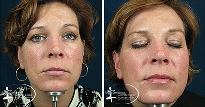 BOTOX Before and After Reston VA