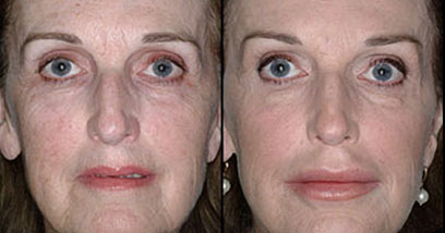 Juvederm Before and After Patient Reston VA