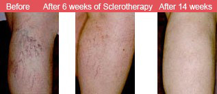 Sclerotherapy After 6 Weeks | Sclerotherapy After 14 weeks Reston VA