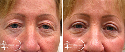 Eyelid Surgery Before and After Reston VA