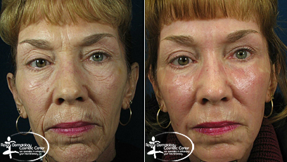 Laser Resurfacing Before and After Reston VA