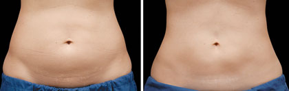 Body Contouring Before and After Reston VA