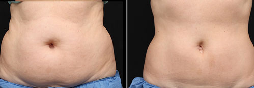 Body Contouring Before and After Reston VA