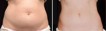 Body Contouring Before and After Reston VA