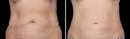 Body Contouring Before and After Reston VA