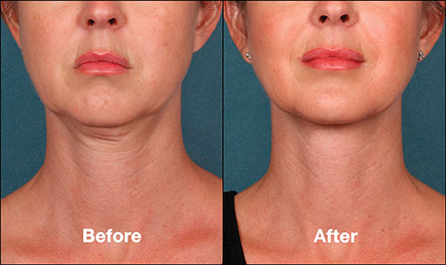 Health Check: How To Nonsurgically Get Rid of Bra Line Fat with Kybella® Fat  Melting Injections 