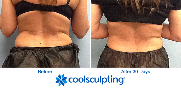 How to Get Rid of Your Muffin Top: the CoolSculpting Approach - Reston  Dermatology + Cosmetic Center