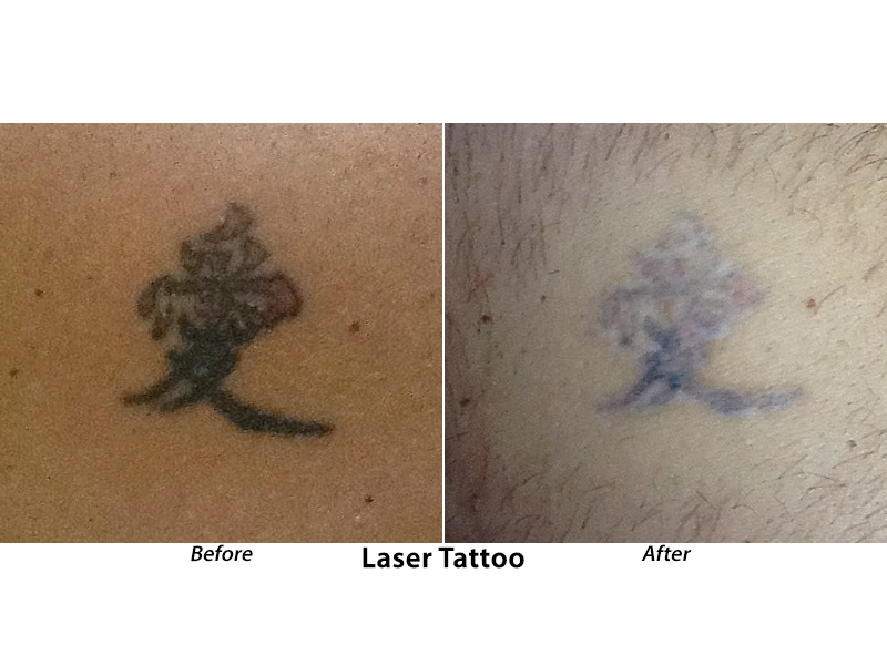 Laser Skin Rejuvenation | Laser Hair Removal | Tattoo Removal Reston VA