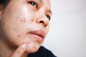 Cystic Acne