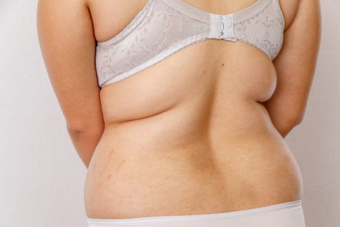Kybella Bra Fat
