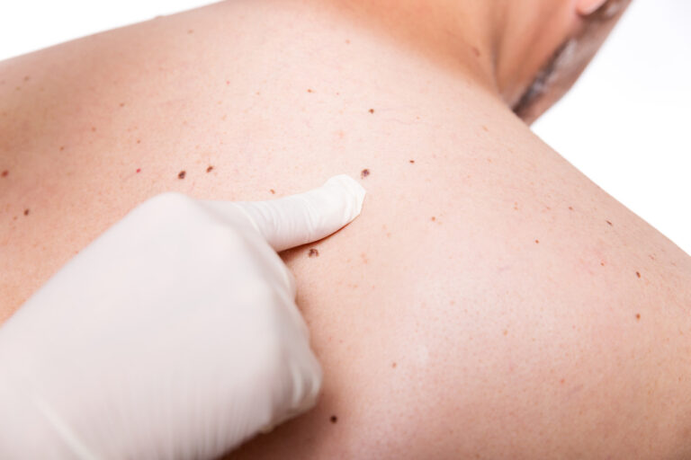 Skin Cancer Check