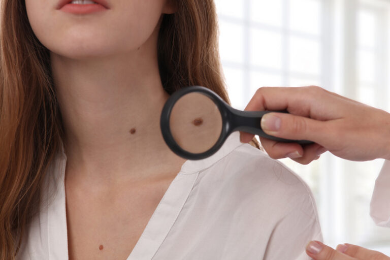Skin Cancer Check