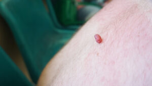 Skin Tag Removal Reston