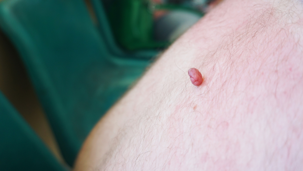 Skin Tag Removal!!! 