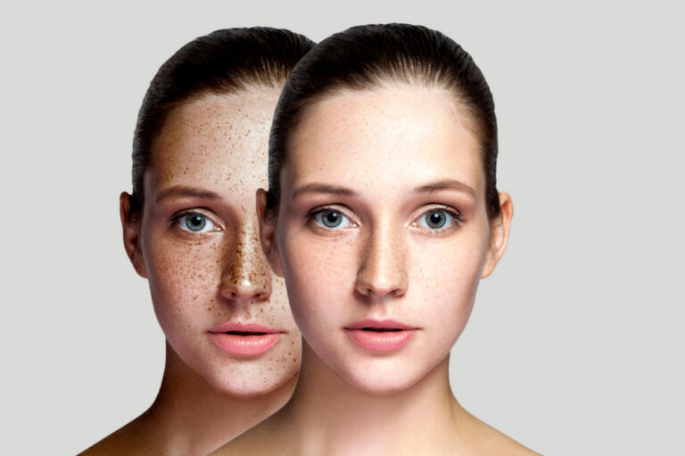Laser Treatment for Age Spots