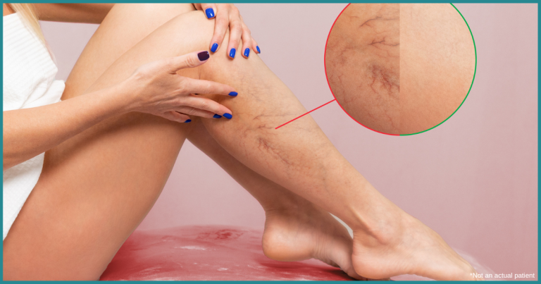northern virginia spider vein treatment