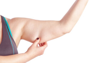 CoolSculpting for Arm Fat