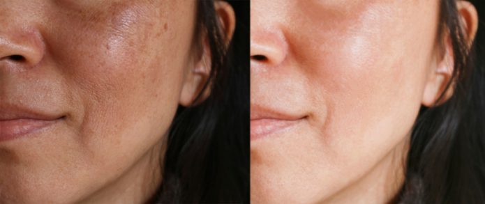 Laser Treatment for Age Spots