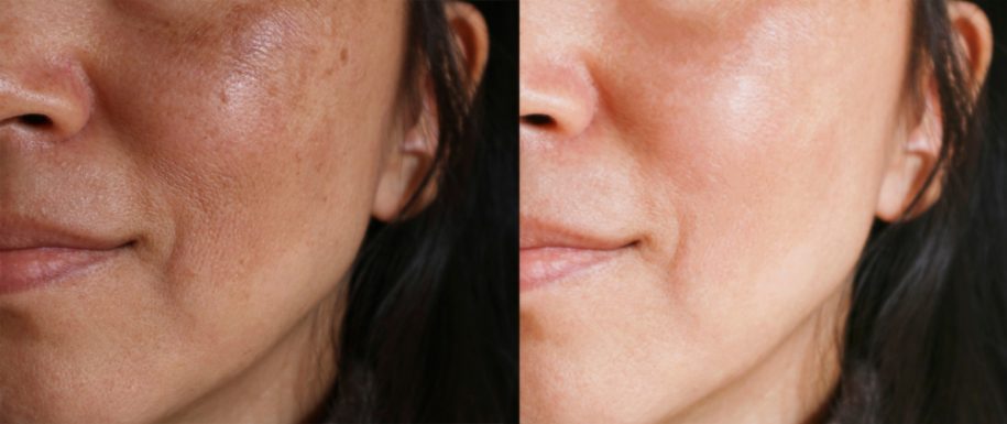 laser-treatment-for-age-spots-reston-dermatology-cosmetic-center