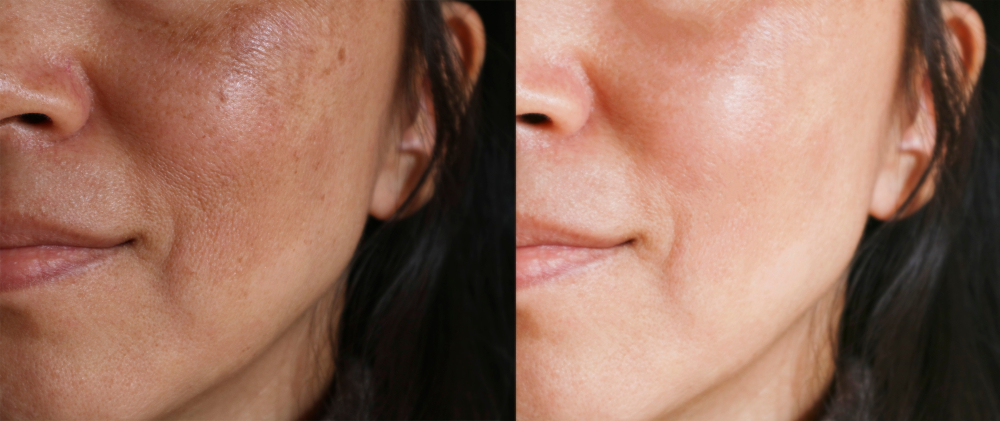 Laser Treatment for Age Spots