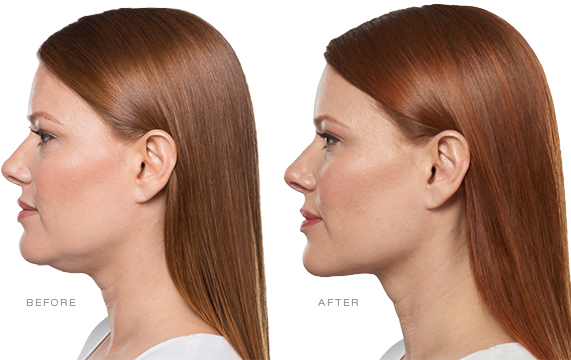 Kybella for Bra Fat in Northern Virginia  Fairfax, Falls Church, Virginia  - Dontage