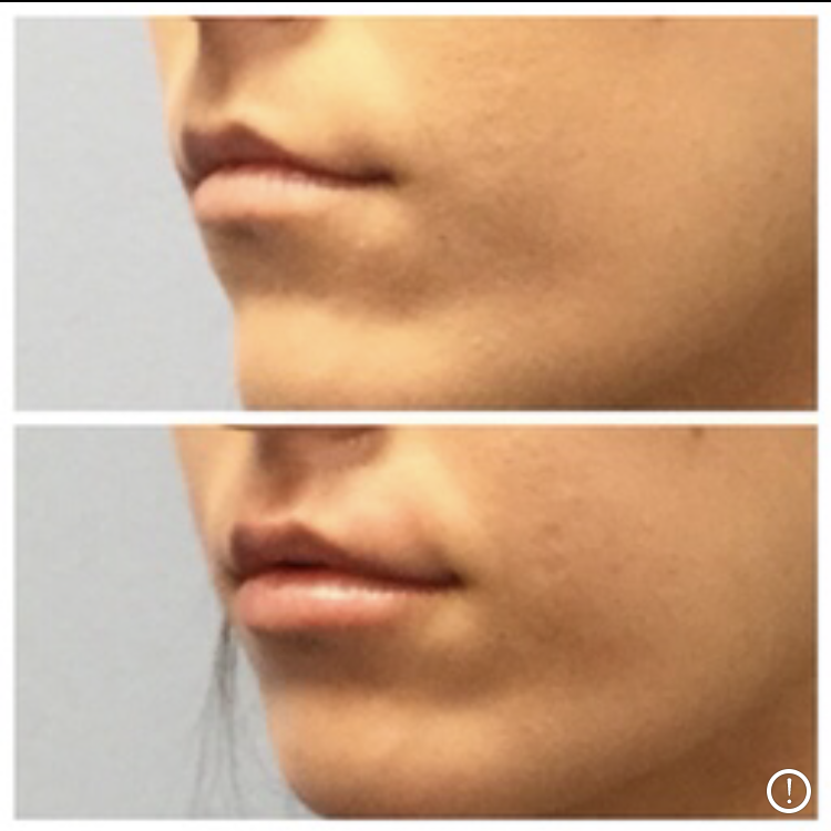 Which Injectable Fillers Are Best for M Shaped Lips?