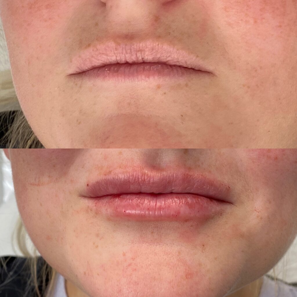 Lip Injections Reston Dermatology + Cosmetic Center
