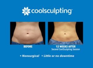 CoolSculpting Cost