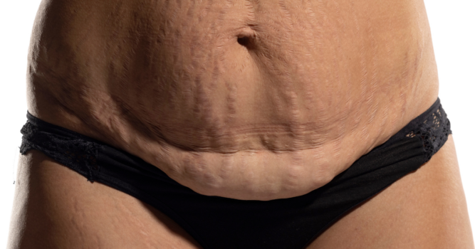 body contouring after weight loss in Virginia