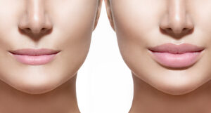 Thin Lips Treatment