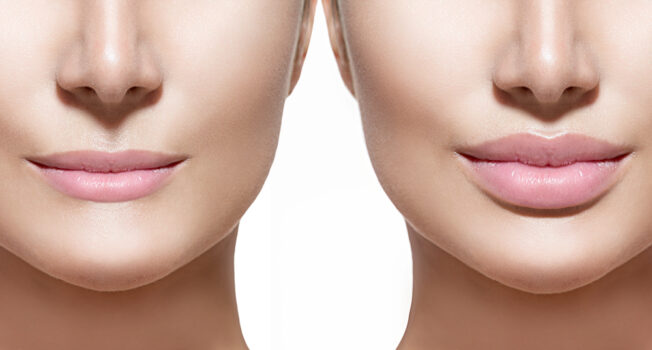 Thin Lips Treatment