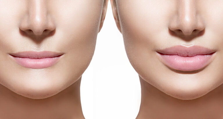 Thin Lips Treatment