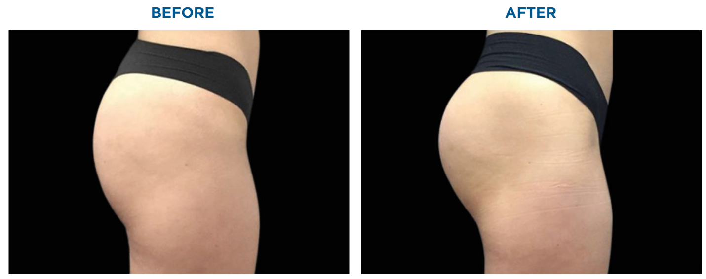 How to Get a Bigger Buttocks Fast - Reston Dermatology + Cosmetic