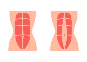 Diastasis Recti Treatment Northern Virginia