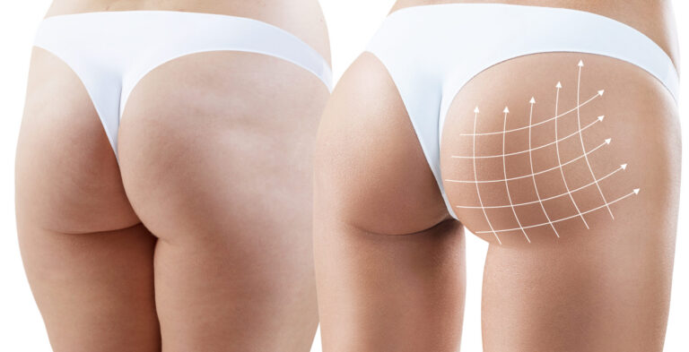 body skin tightening