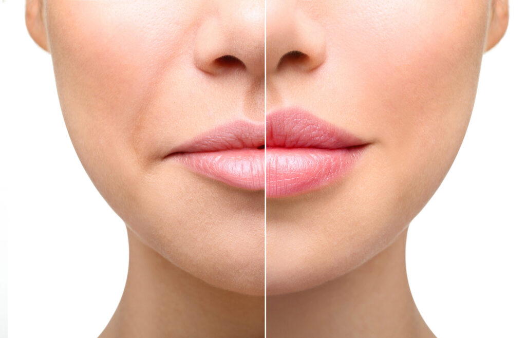best lip filler near me