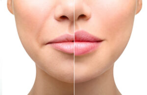 best lip filler near me