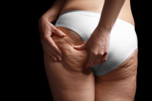 QWO Cellulite Treatment