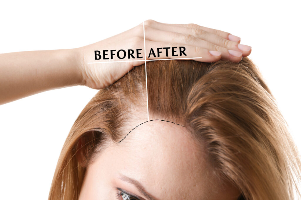 PRF for Hair Loss