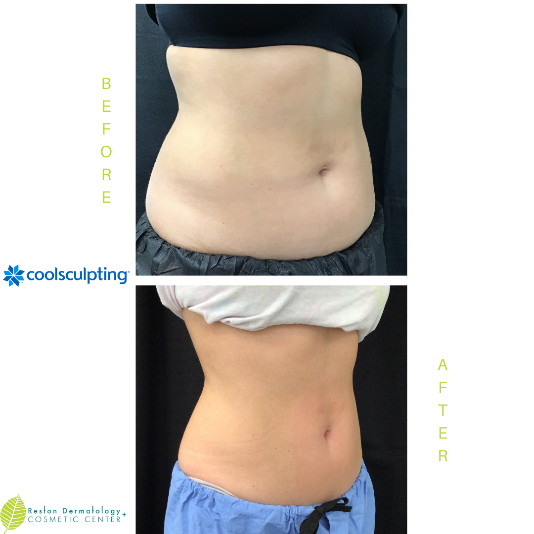 CoolSculpting for C Section Pouch - Reston Dermatology + Cosmetic