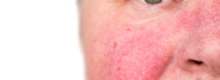 facial redness treatments