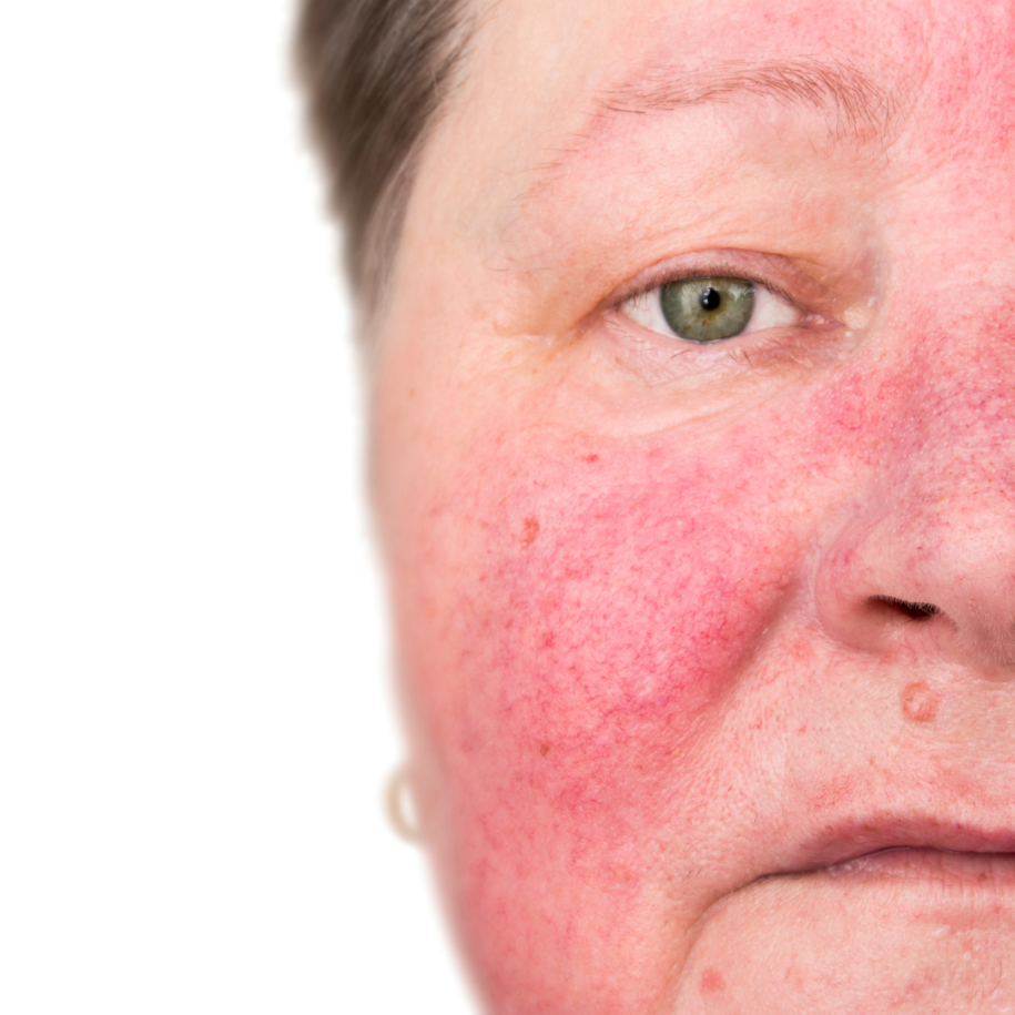 facial redness treatments