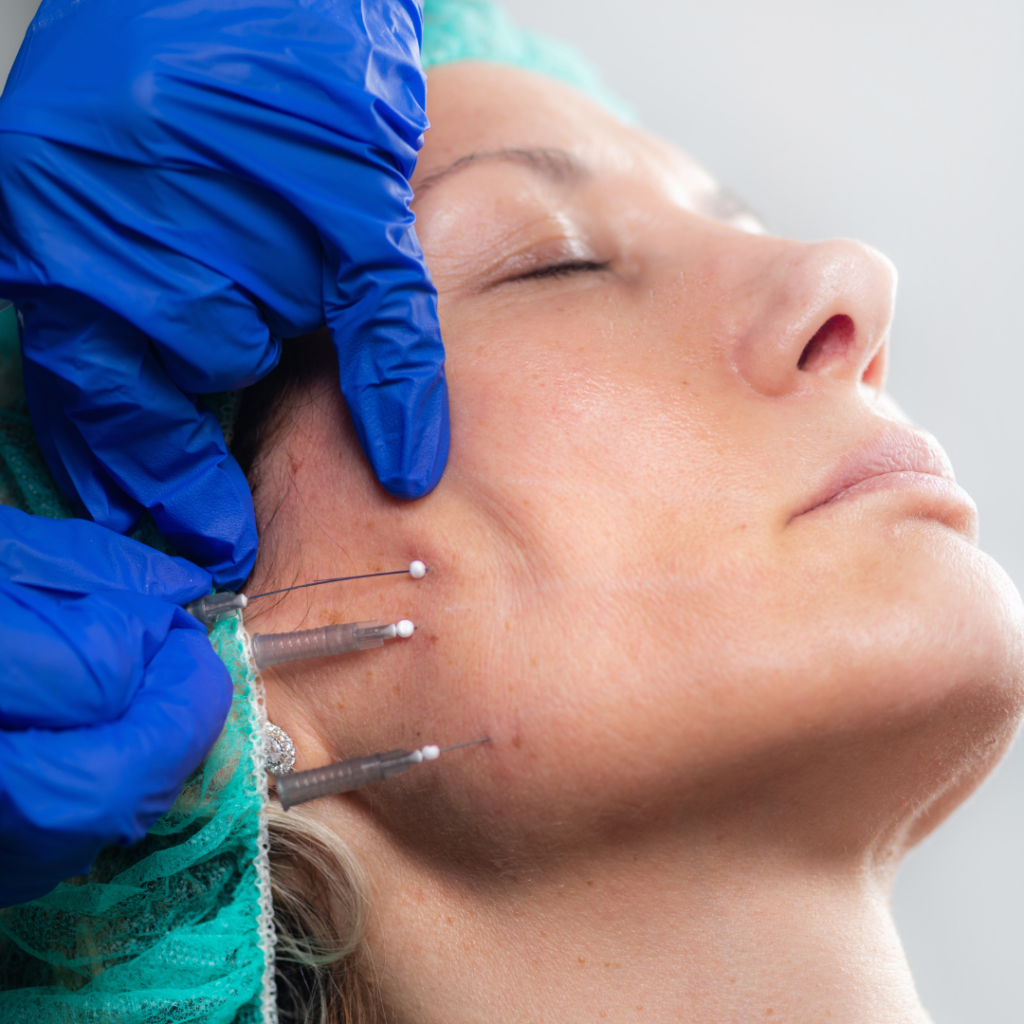 Silhouette Thread Lift The NonSurgical Face Lift Reston