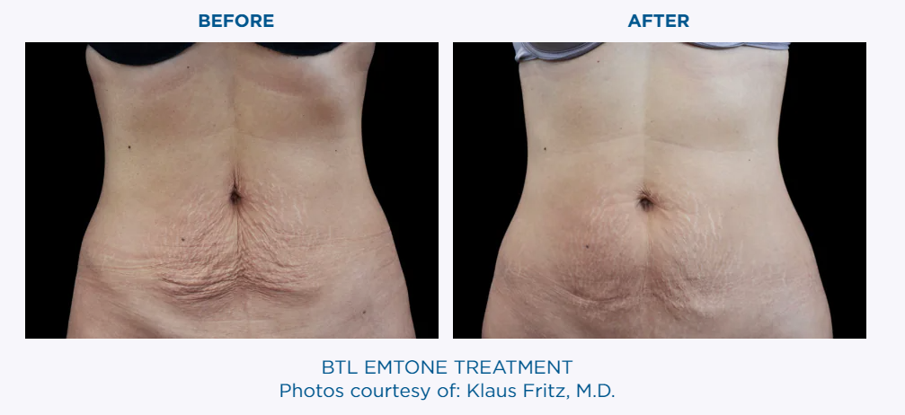 Skin tightening - Reston Dermatology + Cosmetic Center