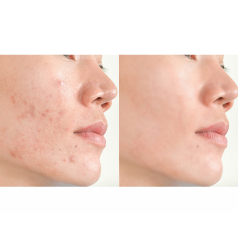 Top Holistic Acne Supplements